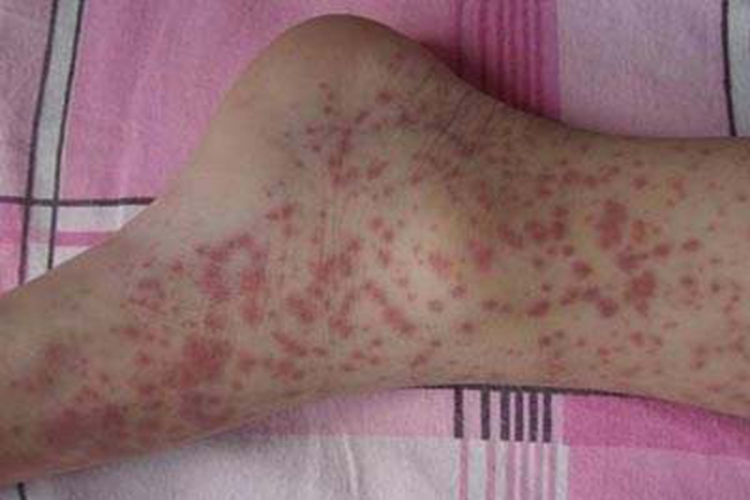 过敏性紫癜脚踝处发紫图
