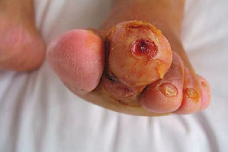 坏死性筋膜炎有坑图