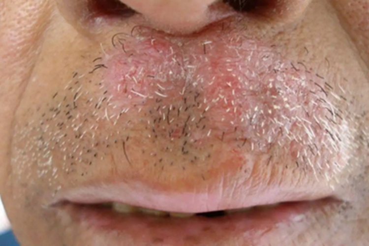 寻常型银屑病症状图 寻常型银屑病症状图