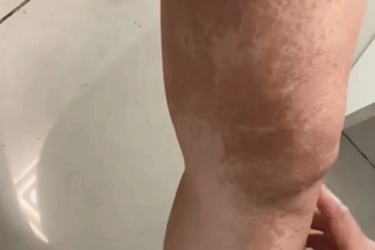 贝克痣大腿上长褐色斑图