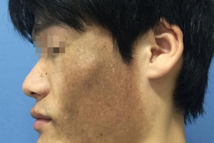 贝克痣面部症状图