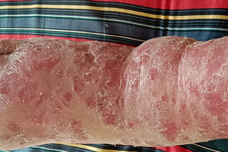 慢性湿疹脚背脱屑图