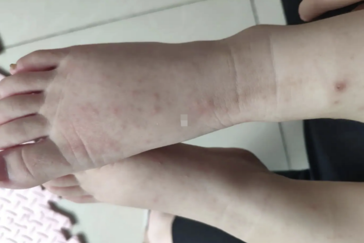 汗疱疹脚背起丘疹图 汗疱疹脚背起丘疹图