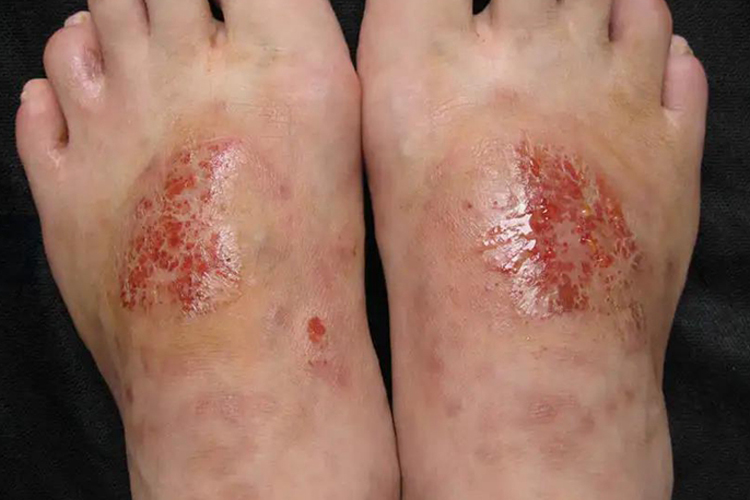双足对称性湿疹图