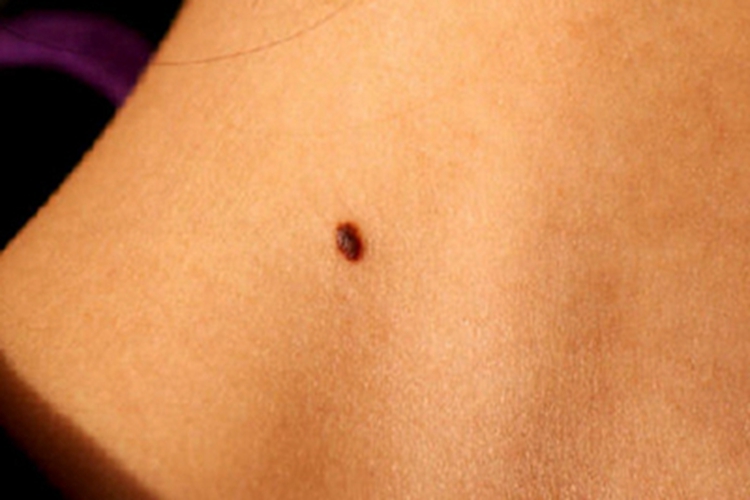 浅表播散型黑色素瘤脖子长黑痣图 浅表播散型黑色素瘤脖子长黑痣图