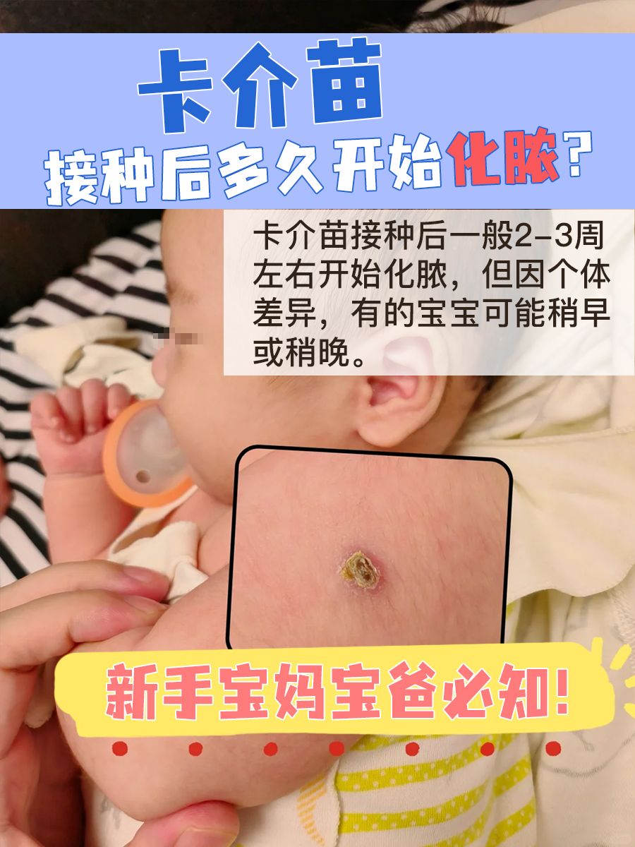 卡介苗接种后多久开始化脓？新手宝妈宝爸必知