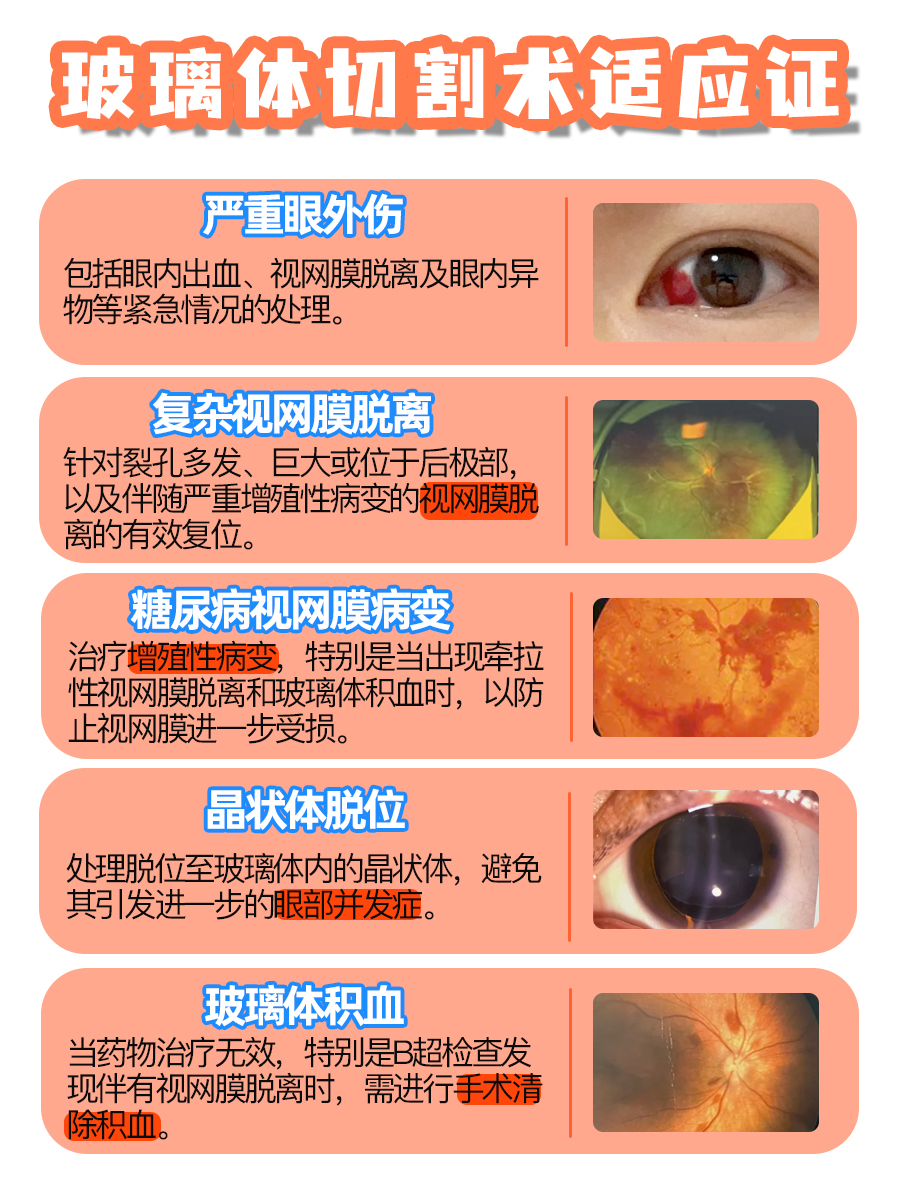 波切手术费用，一文全讲清！