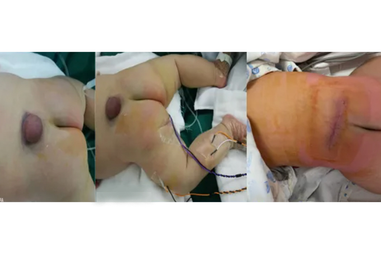 骶骨裂正确睡姿图 骶骨裂正确睡姿图