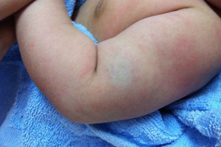 硬肿病胳膊僵硬图