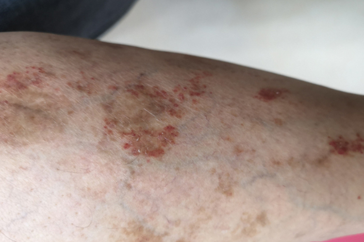 腿部毛细血管环状紫癜图