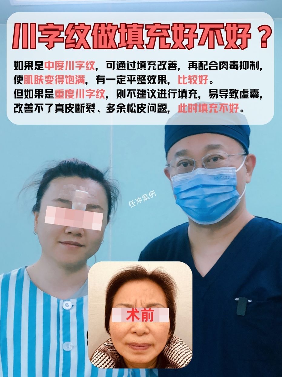 医生告诉你！川字纹填充，好与不好？