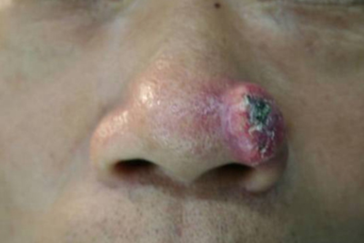 皮肤鳞状细胞癌鼻翼黑痂图