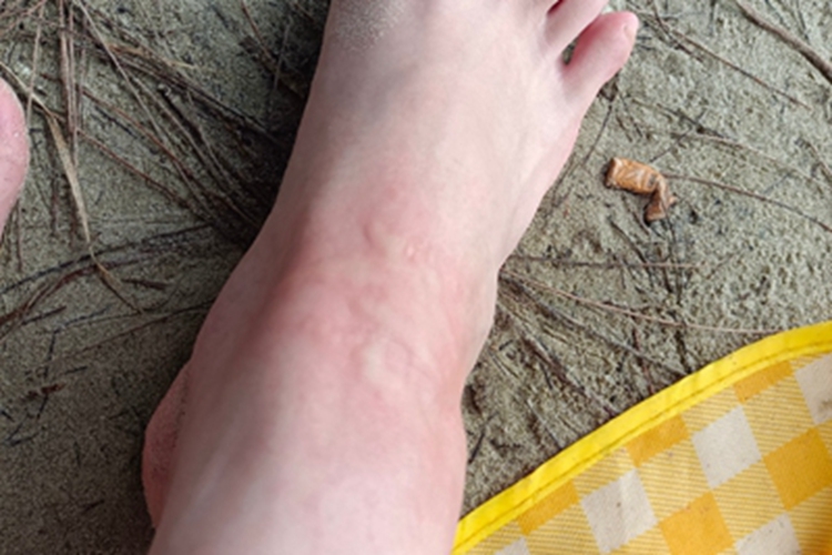 海蜇蜇伤脚背疙瘩图