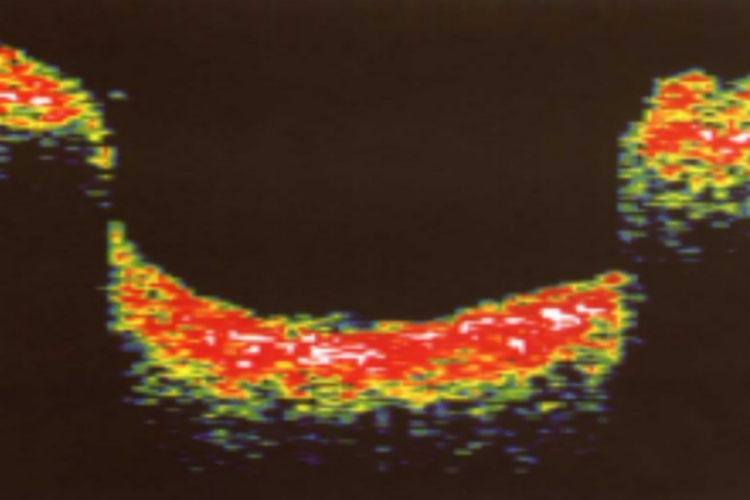 视盘凹陷扩大图