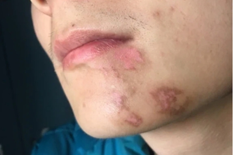 非节段型白癜风下巴长斑图