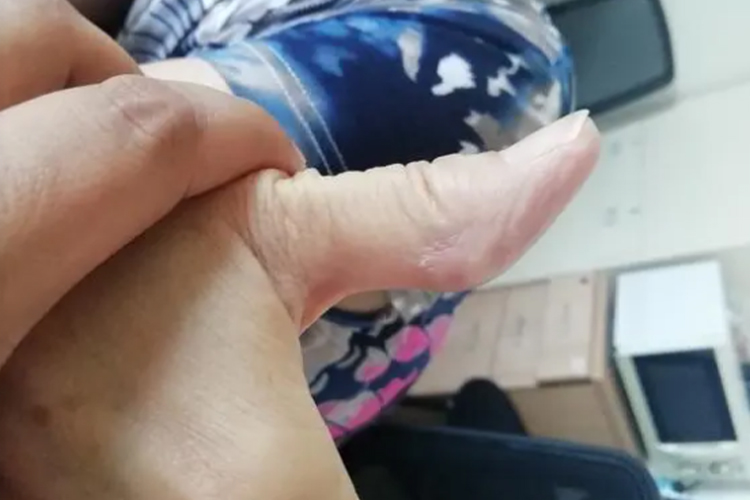 大拇指腱鞘巨细胞瘤图