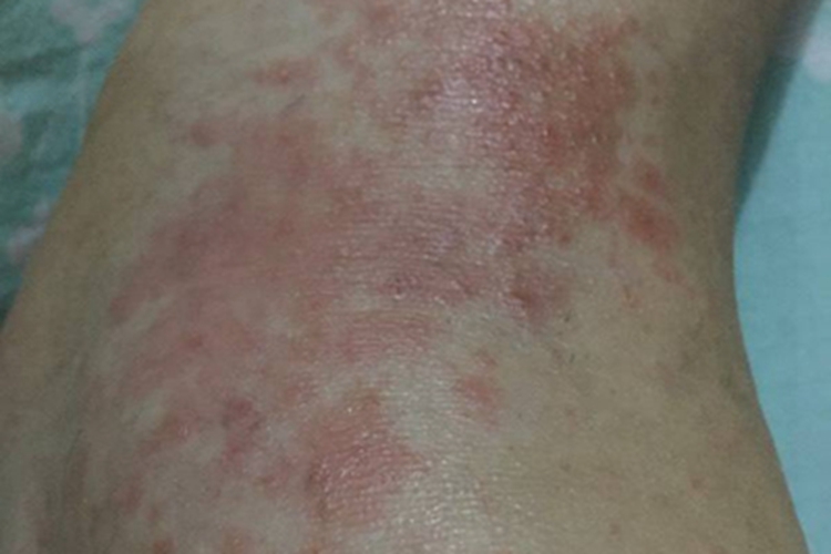 柯萨奇湿疹脚腕红斑和小疱图