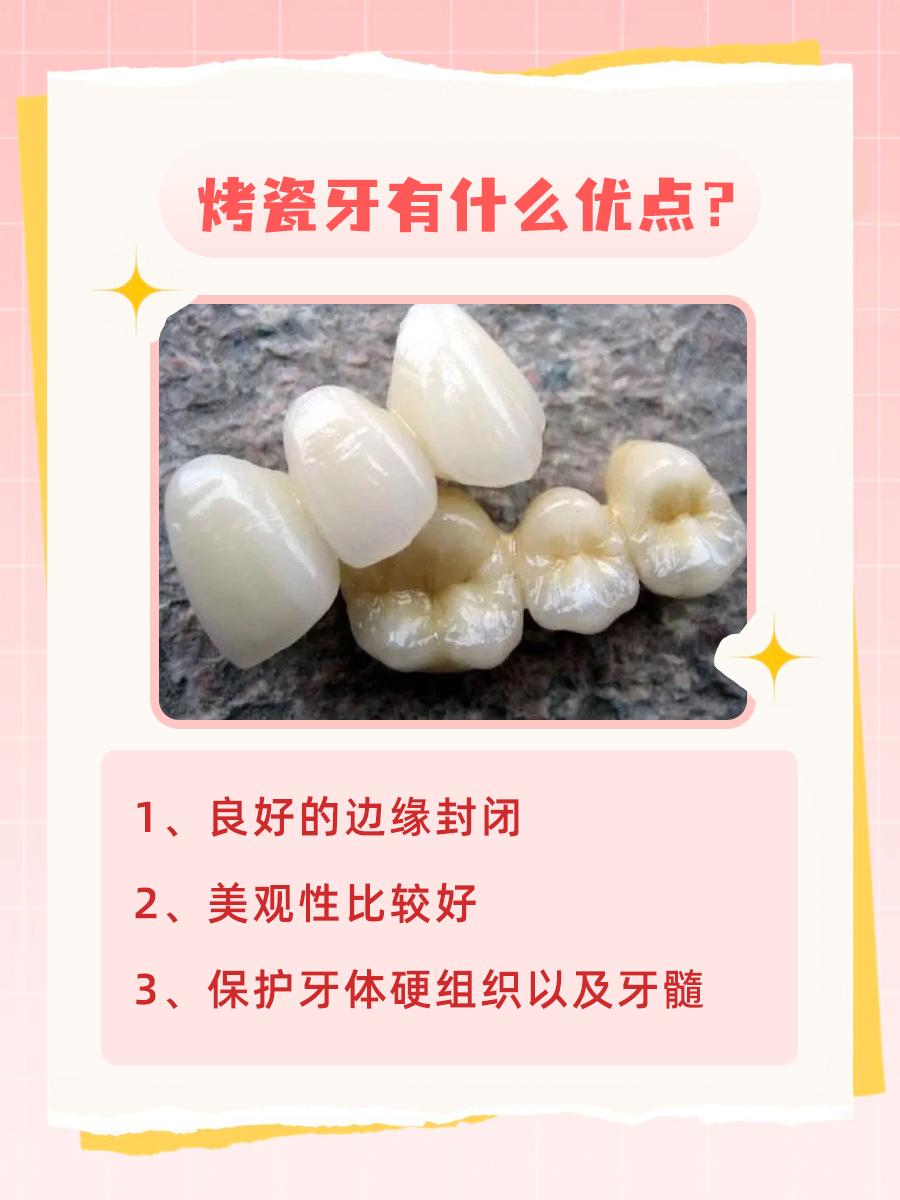 做完烤瓷牙，生活中要注意哪些方面呢？