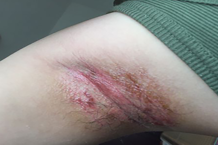 腋下湿疹红斑图