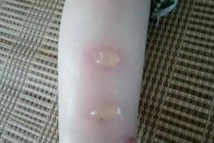 蜂蛰伤小腿水疱图 蜂蛰伤小腿水疱图