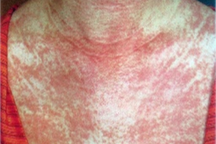 无肌病性皮肌炎胸部症状图