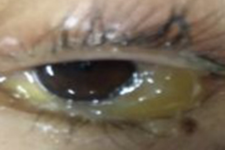 暴露性角膜炎眼部症状图