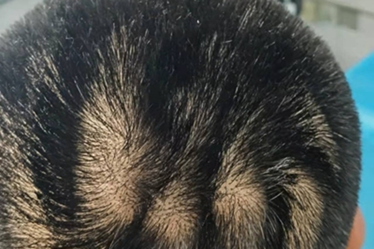 回状颅皮症状图 回状颅皮症状图