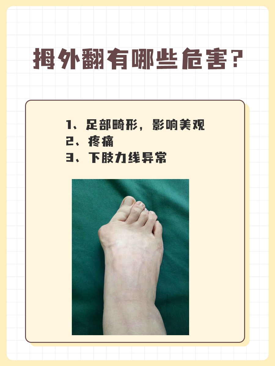 拇外翻怎么矫正?医生分享3个方法!