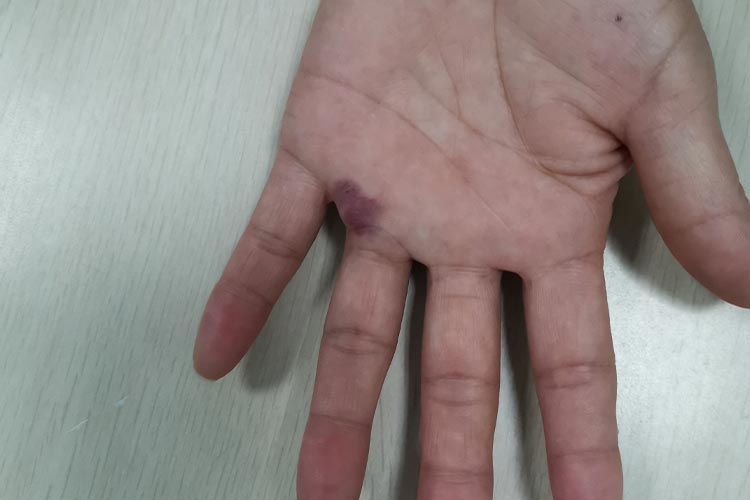 深在性红斑狼疮图