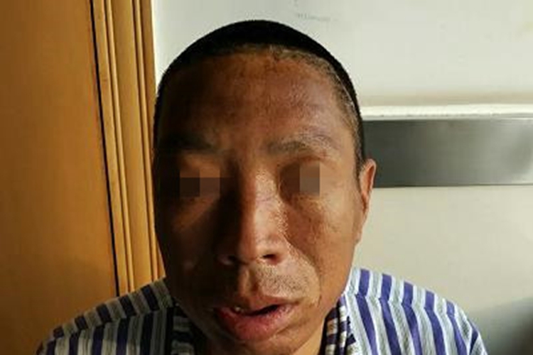 肢端肥大症畸形图