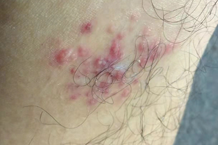 带状疱疹丘疹图