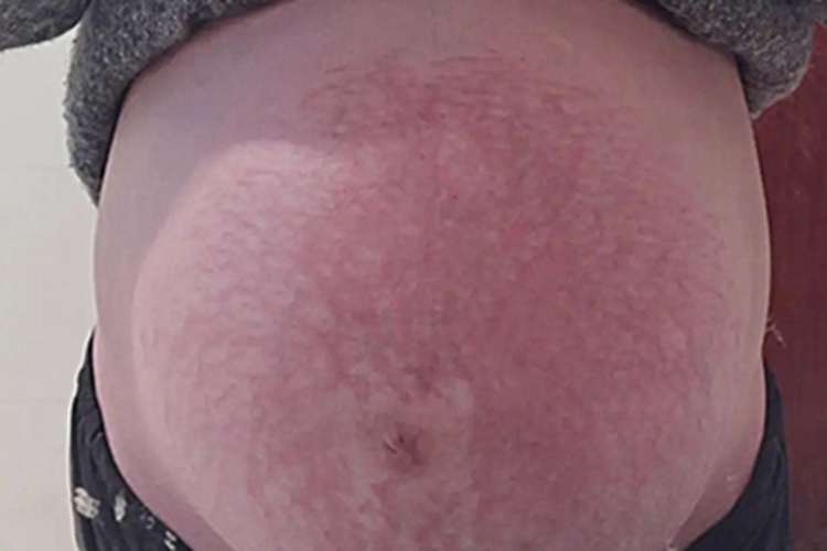 妊娠瘙痒症条纹图 妊娠瘙痒症条纹图