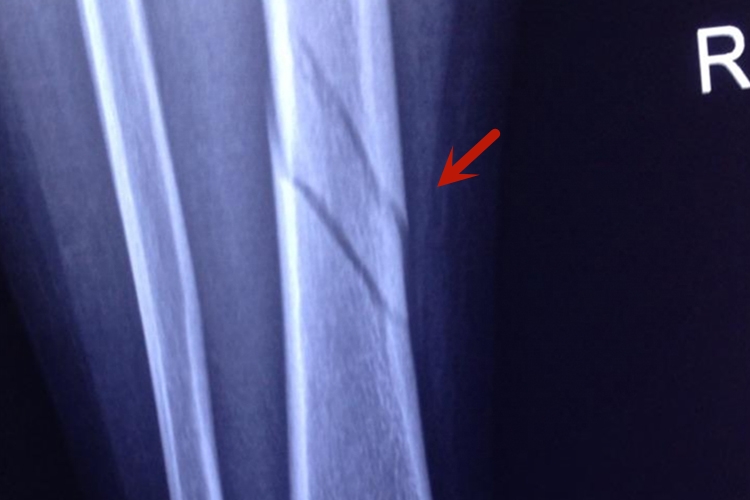 小腿胫骨骨折图