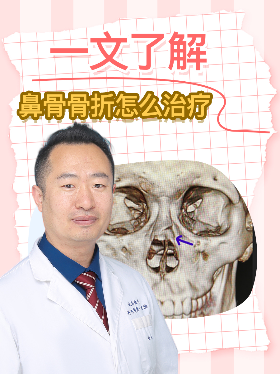 一文了解:鼻骨骨折怎么治疗