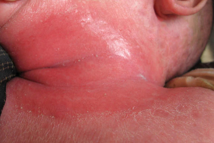 颈部间擦疹典型皮损图 颈部间擦疹典型皮损图