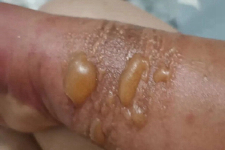 海蜇蜇伤胳膊症状图