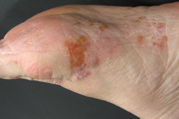 水疱型足癣脱皮图