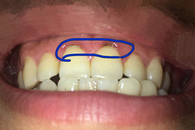 龈下结石牙齿边缘发黑图 龈下结石牙齿边缘发黑图