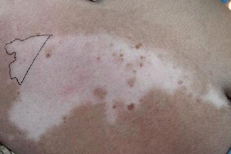 特发性点状色素减退斑腹部白斑图