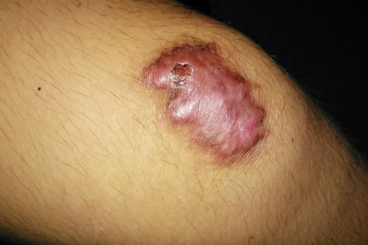 膝盖瘢痕疙瘩图 膝盖瘢痕疙瘩图