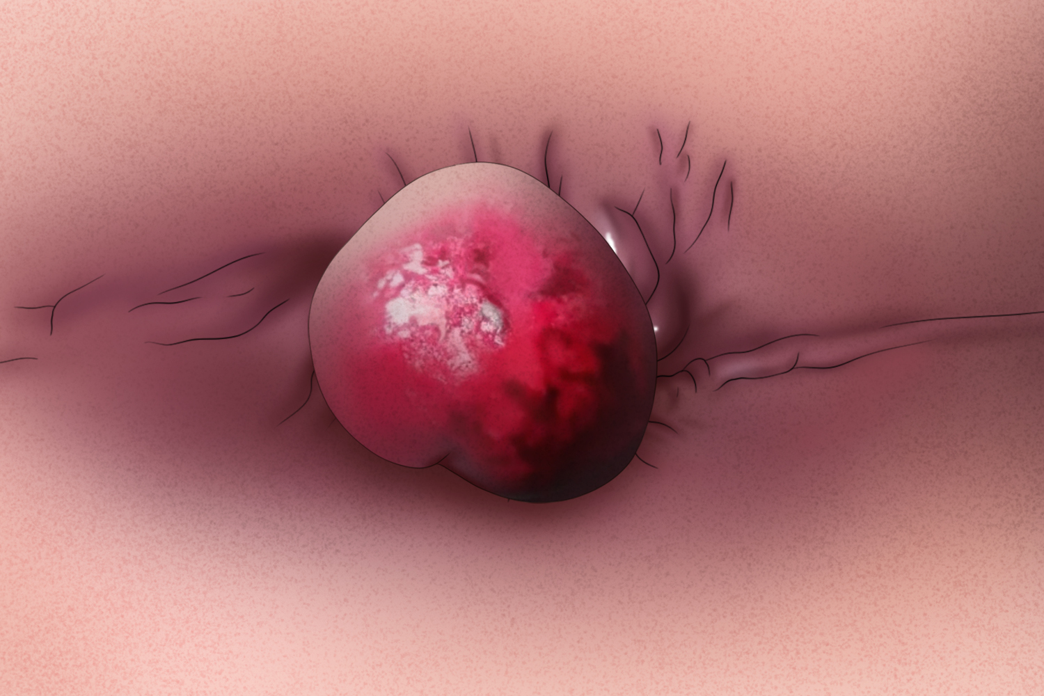 直肠脱垂图 直肠脱垂图