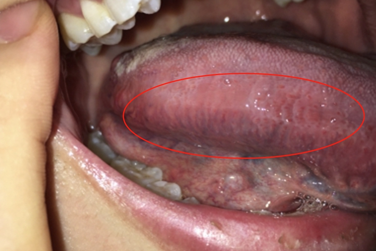 舌炎舌侧条纹图