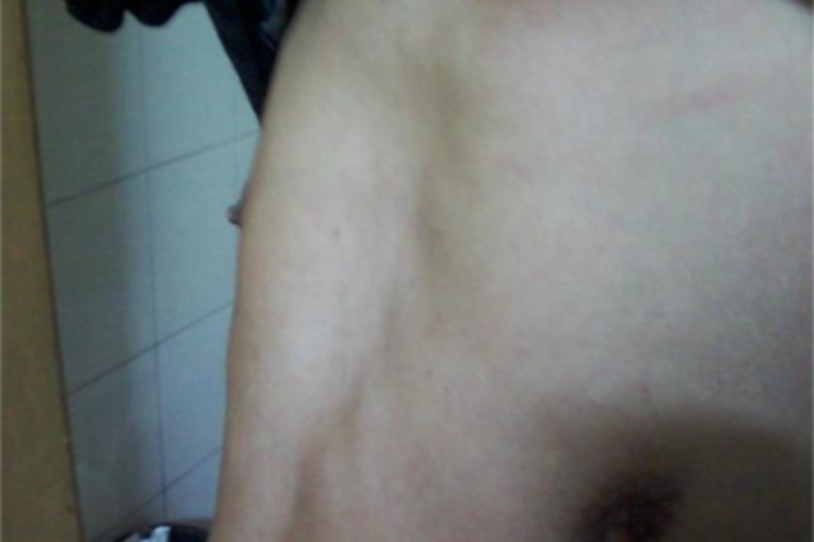 马方综合征胸骨呈漏斗状大坑图 马方综合征胸骨呈漏斗状大坑图