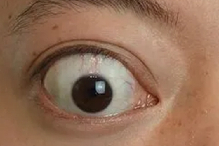 非炎性单纯性突眼眼部症状图 非炎性单纯性突眼眼部症状图