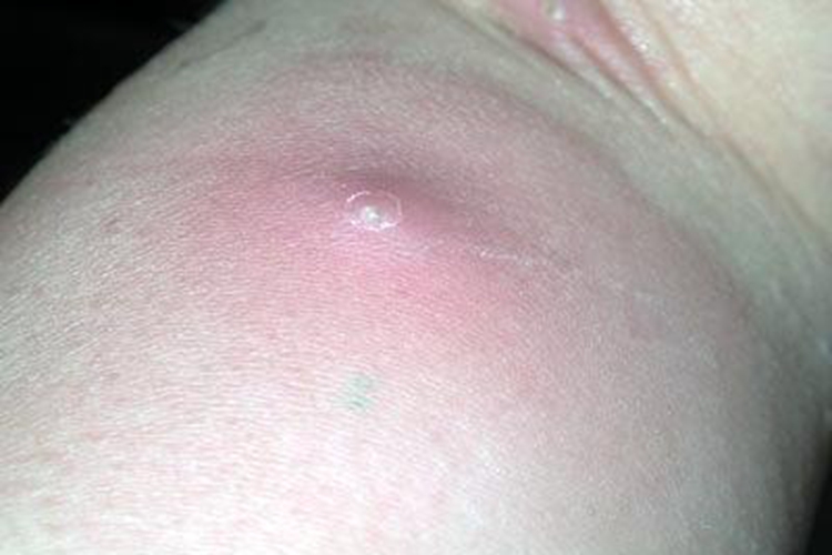 腿上疖长脓包图