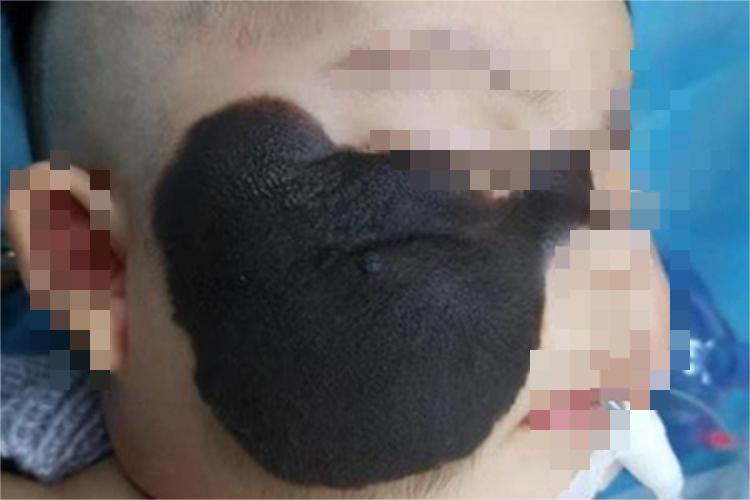 兽皮痣面部症状图