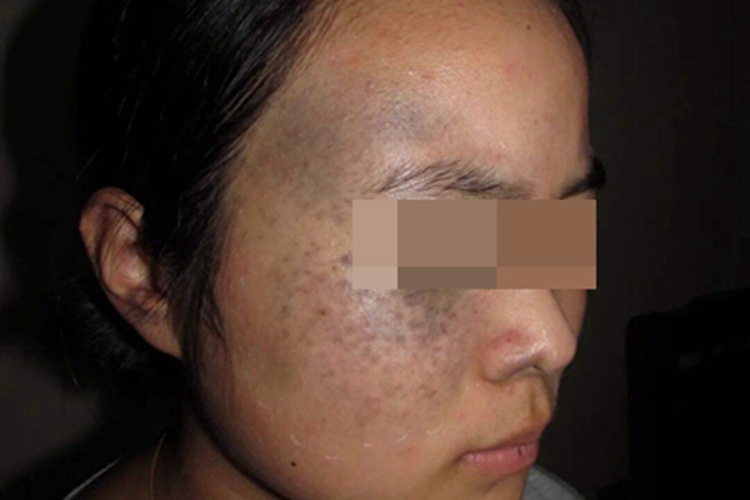 太田痣脸上有密集斑点图