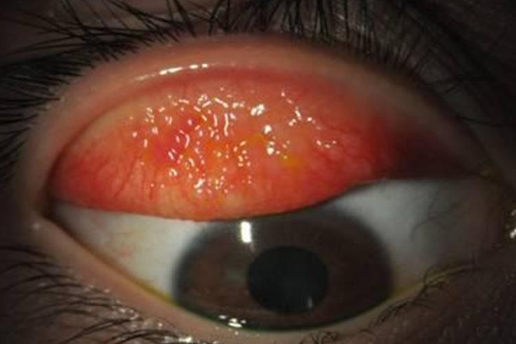 过敏性结膜炎图