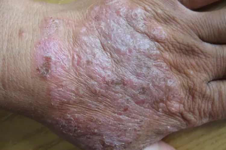 湿疹结痂伴红斑图