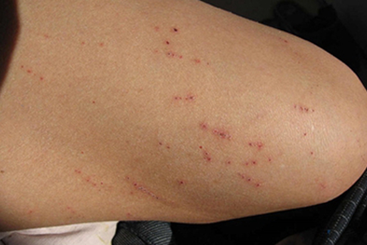 寄生虫妄想症大腿症状图